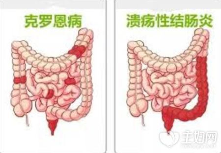 不健康的饮食习惯导致罕见克罗恩病