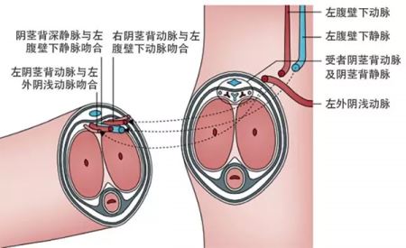 报告：三年前接受下体移植的男性已恢复正常功能