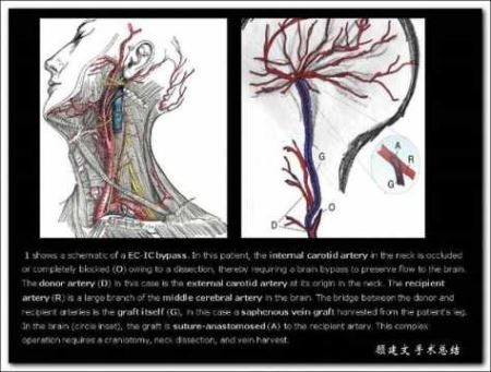 脑血管不通时是怎样搭桥重建的