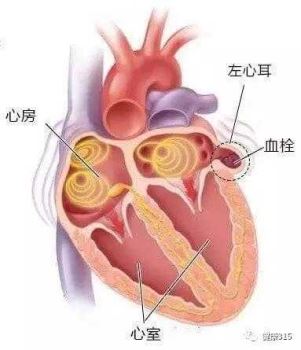 河南省独立完成首例左心耳封堵术治疗房颤健