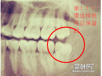 拔完智齿侧面长骨刺 拔牙后牙龈外侧有硬物