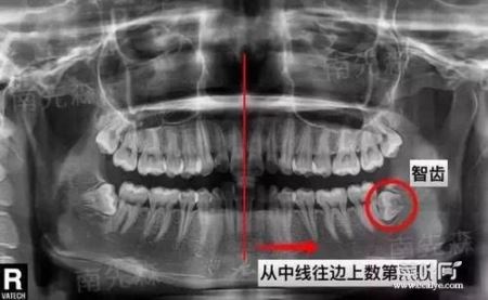 拔完智齿侧面长骨刺 拔牙后牙龈外侧有硬物