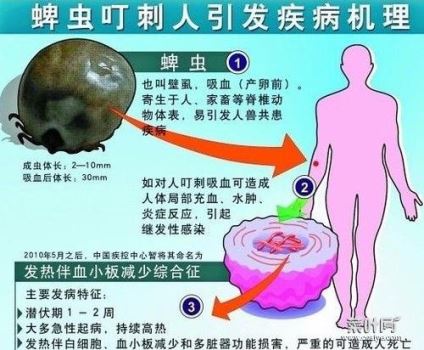 风油精治蜱虫么 蜱虫叮咬后如何治