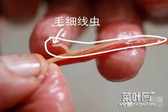 人体红色寄生虫 人体寄生虫面条虫图片