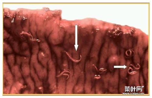 人体红色寄生虫 人体寄生虫面条虫图片
