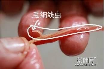 人体红色寄生虫 人体寄生虫面条虫图片