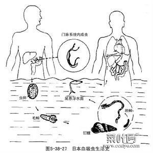 血吸虫肝病 血吸虫肝病症状