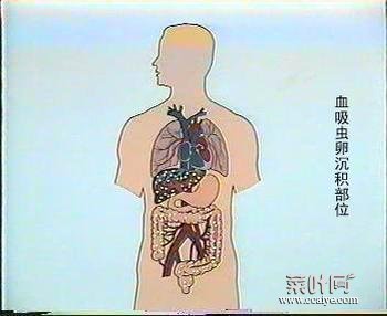 血吸虫肝病 血吸虫肝病症状