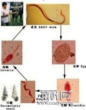 血吸虫肝病 血吸虫肝病症状