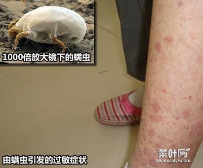 很多螨虫视频 筷子刮螨虫揭秘视频