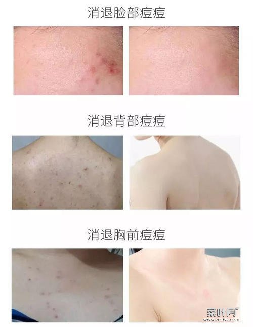 螨虫和粉刺的不同 粉刺挤出来的螨虫图片