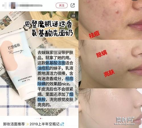 螨虫和粉刺的不同 粉刺挤出来的螨虫图片