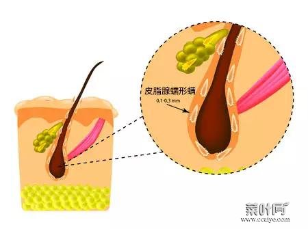 脸部除螨虫的简单方法 脸上一摸全是小颗粒