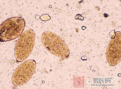 肝吸虫病能自愈 如何检查肝吸虫