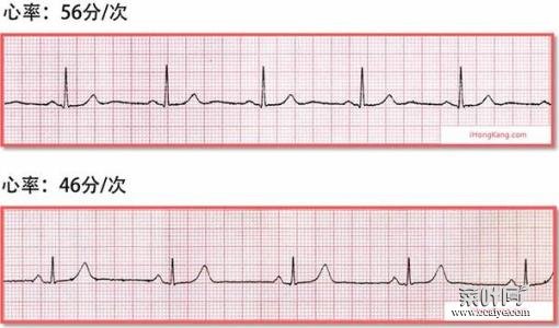 心率高于100说明啥 心跳过快如何缓解