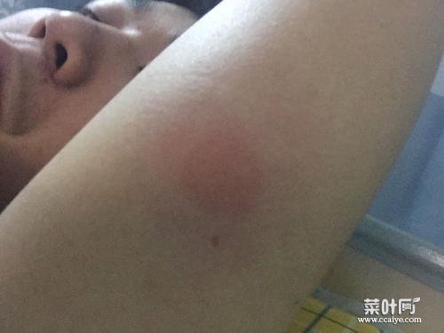 胳膊肿起大包硬块痒 腿上肿瘤的症状10大前兆