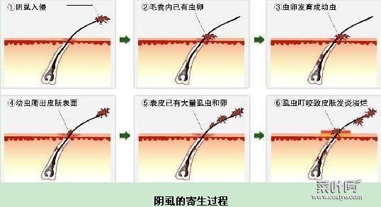 阴虱会爬到头发上吗 阴虱会不会爬到全身各处咬