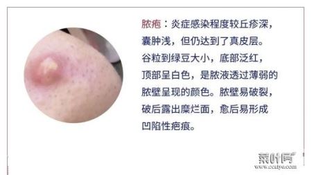 皮脂囊肿会自己消失吗 皮脂腺囊肿能挤出来吗