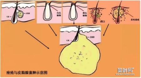 皮脂囊肿会自己消失吗 皮脂腺囊肿能挤出来吗