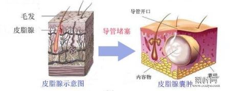 皮脂囊肿会自己消失吗 皮脂腺囊肿能挤出来吗