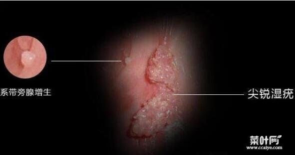 真实女性hpv感染症状初期图，警惕低危型尖锐湿疣/高危型可进展成宫颈癌