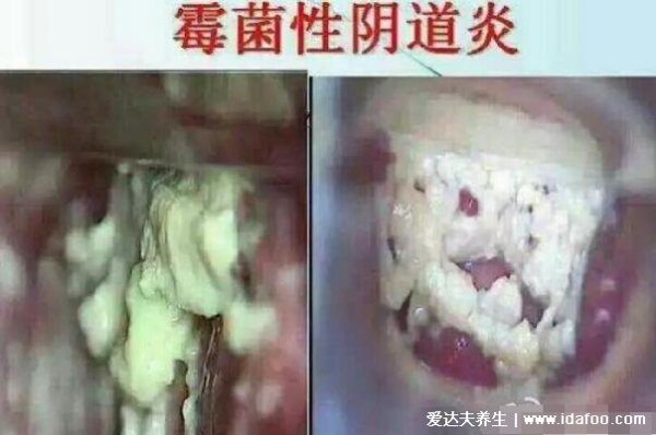 霉菌性阴炎症状大全：豆腐渣白带伴随瘙痒