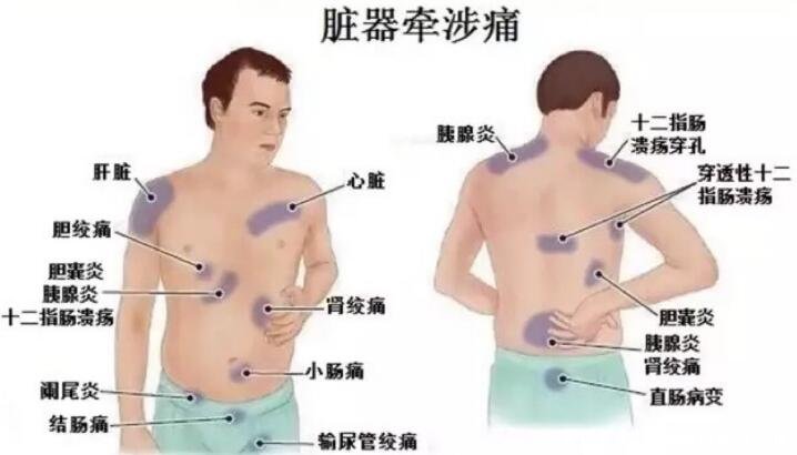 后背疼痛图片位置示意图及病情对比图，警惕后背偏下的消化系统疾病