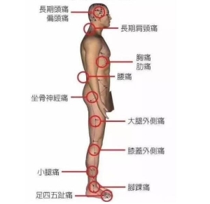 坐骨神经痛的疼点图，教你寻找痛点并消除疼痛(单侧腰部到脚外侧)