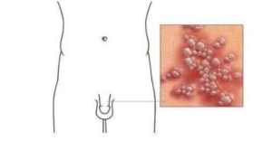 男性疱疹的症状图片大全，早期生殖器疱疹,带状疱疹图合集