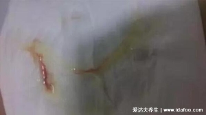 hpv疫苗接种禁忌症和注意事项，10种情况不能打宫颈癌疫苗