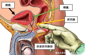 前列腺炎一杯水自测方法不科学，教你对比症状自测更靠谱