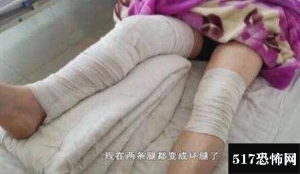 倒霉患者右腿手术左腿被开