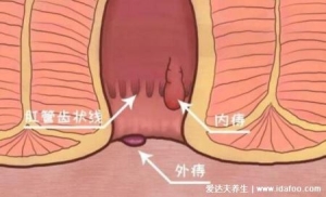 混合痔疮一期二期三期图片，三期咳嗽都有痔块脱垂出来最严重