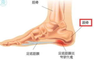 3个足底筋膜炎痛点图片，经常脚后跟疼的注意了(附治疗法)