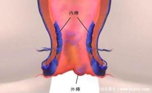 痔疮长什么样子的图片，真实的轻微痔疮图片大全