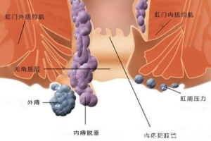 痔疮长什么样子的图片，真实的轻微痔疮图片大全