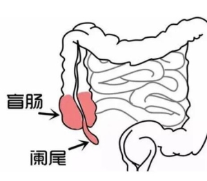 阑尾炎是哪个部位疼位置示意图片，右下腹按压痛(早期上腹肚脐疼)