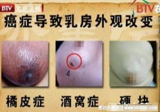 乳腺癌的15个征兆图片，警惕乳房凹陷/乳头溢液/肿块/橘皮样改变