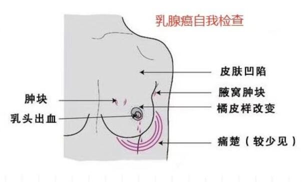 乳腺癌的15个征兆图片，警惕乳房凹陷/乳头溢液/肿块/橘皮样改变