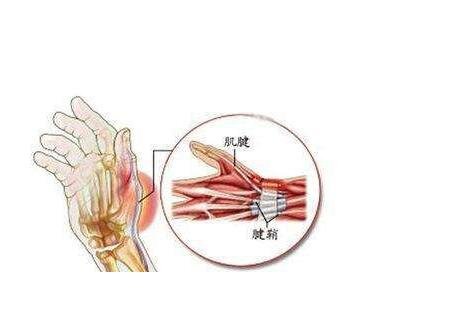 腱鞘炎3个动作自愈方法，试试按摩热敷(过度活动小心加剧)