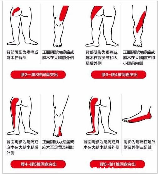 腰肌劳损疼痛的部位图片，注意和腰间盘突出区分(附医治法)