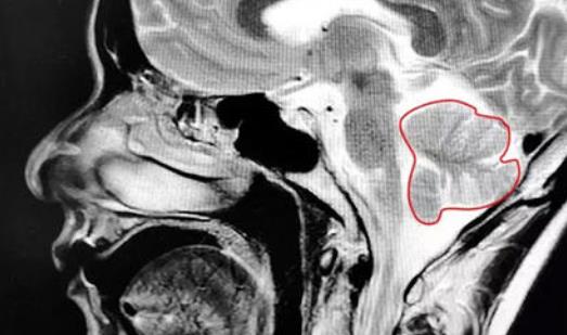 患小脑萎缩的原因及症状，如何预防小脑萎缩