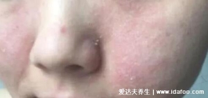 脸部过敏性皮炎图片和症状，丘疹红斑瘙痒幸免抓痒(3种类型图)