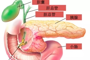 胆囊结石能用排石药吗?排出的石头并非胆结石