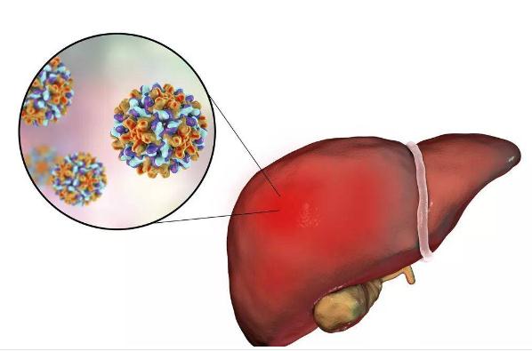 酒精肝和乙肝哪个严重 ？怎么治疗酒精肝?？